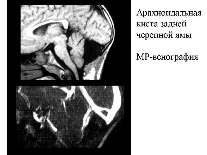Арахноидальная киста задней черепной ямы  МР-венография